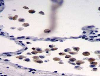 Scientists find 'unknown link' between lung cancer and common parasite