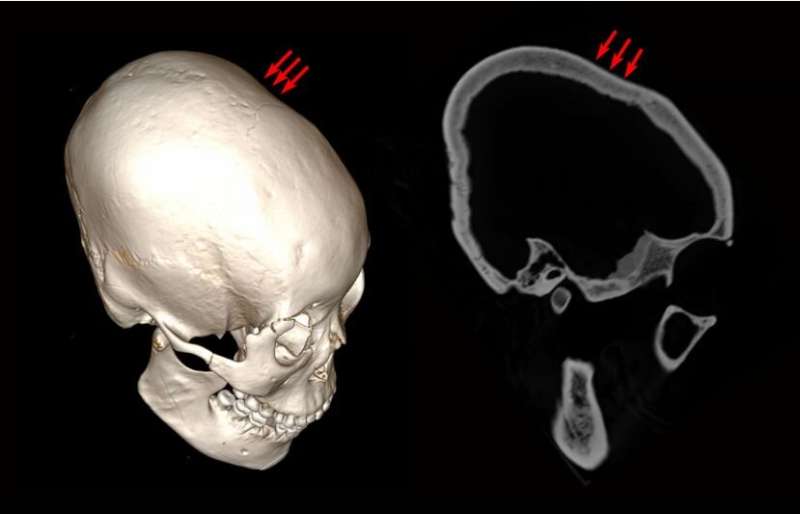 Researchers in China find some of the oldest examples of cranial modification