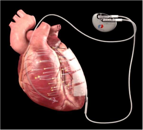 New technique uses microcurrent to exercise heart muscle