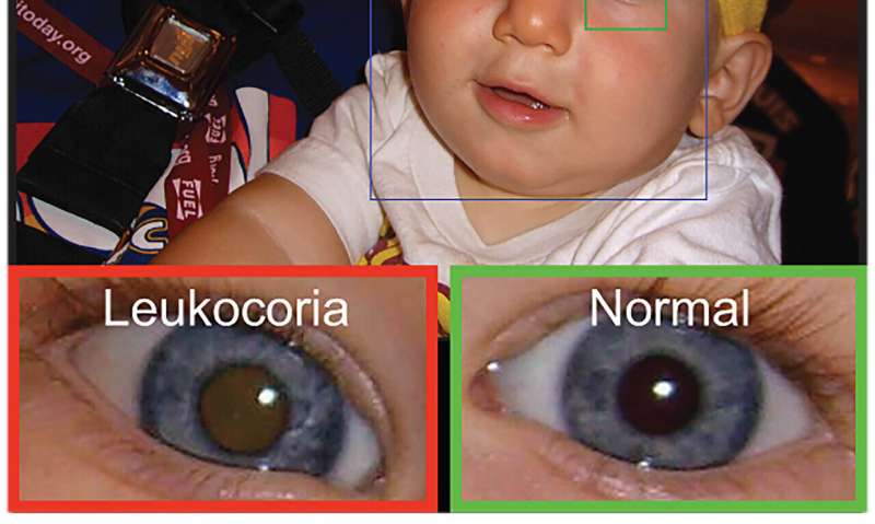 App can detect “white eye” in children’s photos to spot possible problems