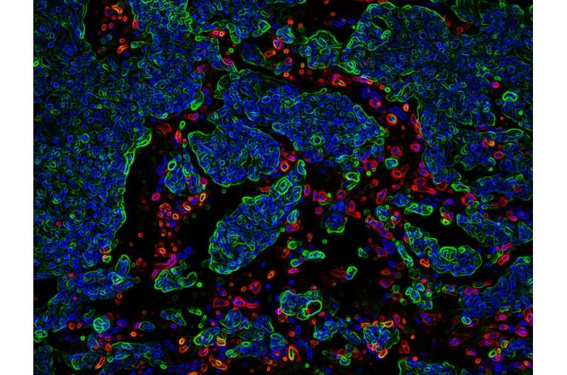 Study shows how circulating tumor cells target distant organs