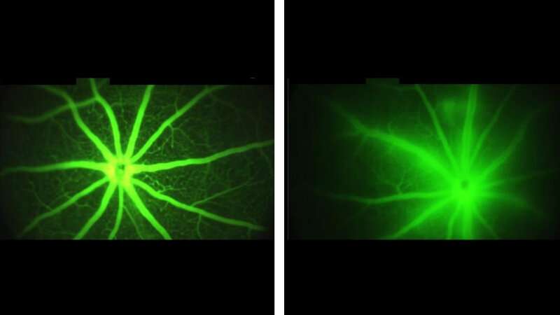 Experimental drug delivers one-two punch to vision loss