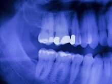 Abnormal binding of proteins impedes creation of crystalline enamel structure, which can lead to bad teeth
