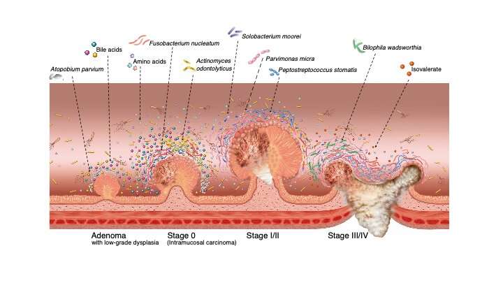 A gut feeling: Microbiome changes may mean early detection of colorectal cancer