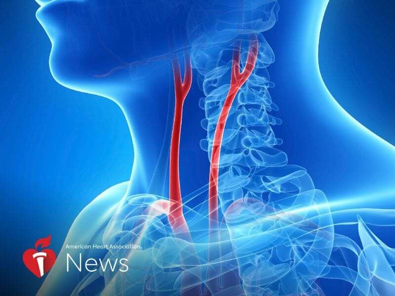 AHA news: study finds higher risk of stroke-linked plaque in men, possible test for women