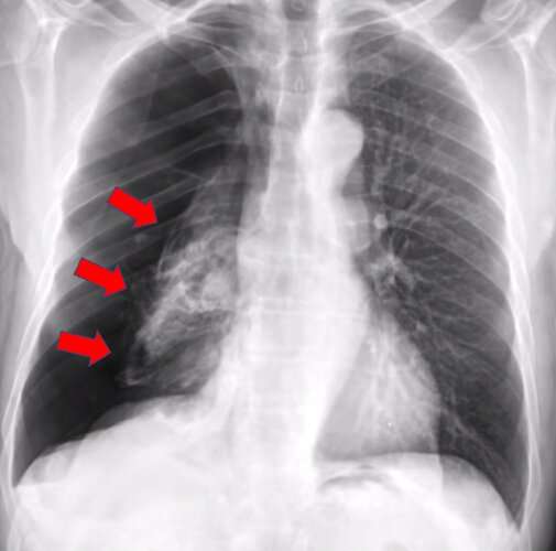 AI system more accurately identifies collapsed lungs using chest x-rays
