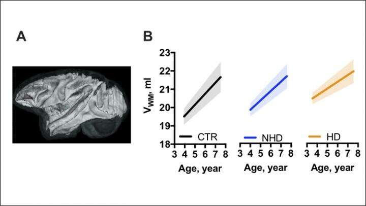 Alcohol drinking slows brain growth in adolescent monkeys