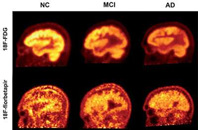 Amyloid is a less accurate marker for measuring severity, progression of Alzheimer's