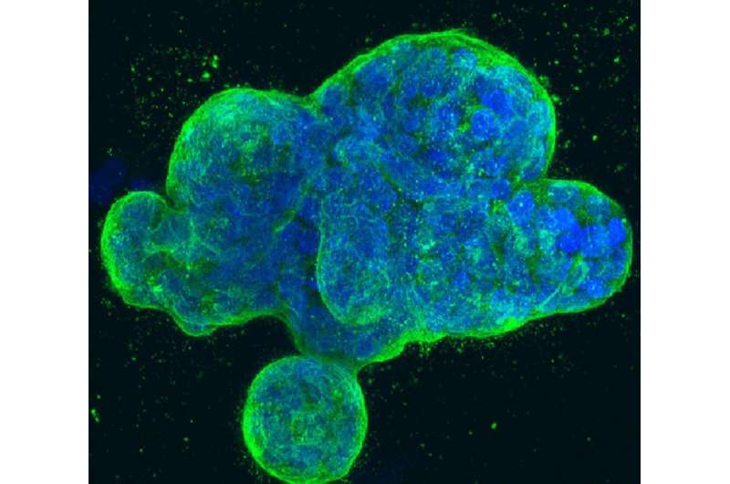 An errant editing enzyme promotes tumor suppressor loss and leukemia propagation