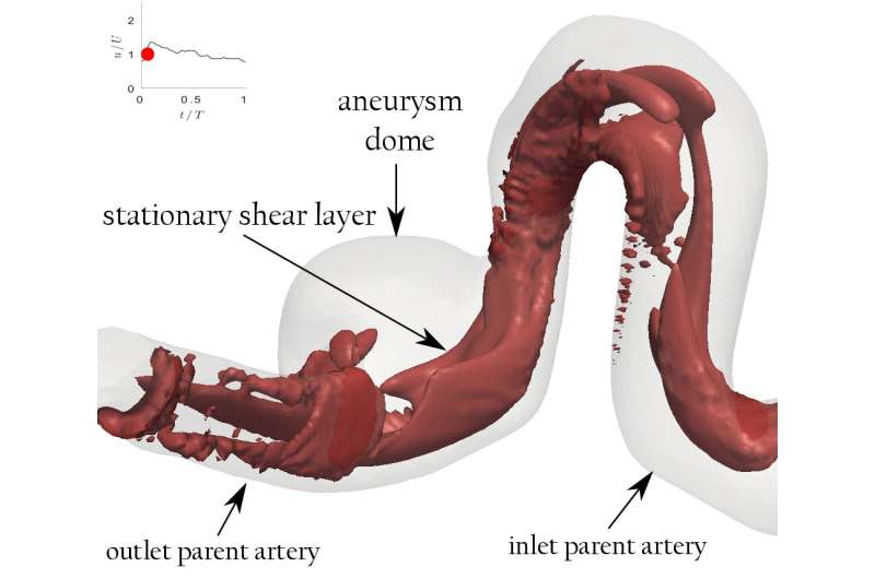 'Aneurysm Number' may help surgeons make treatment decisions