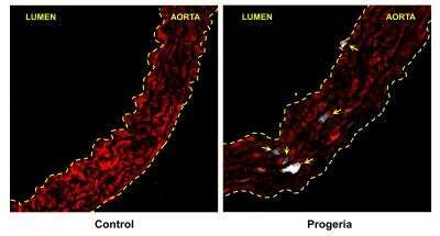 A new therapeutic target for blocking early atherosclerosis in progeria