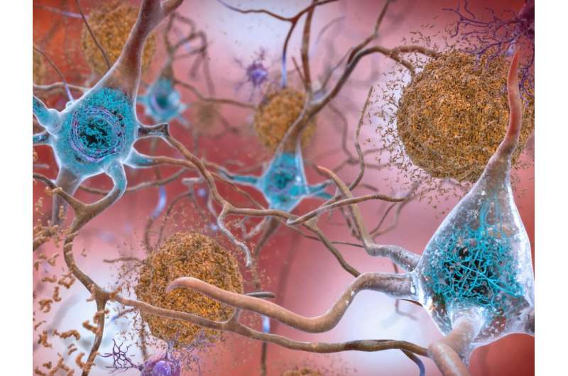 A precise look at Alzheimer’s proteins