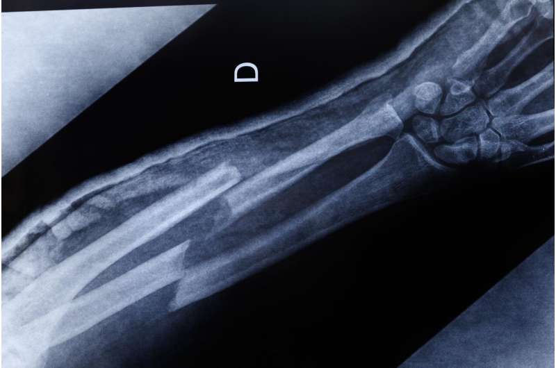Atomic-level analysis of bone aims to predict and lessen fractures in diabetics