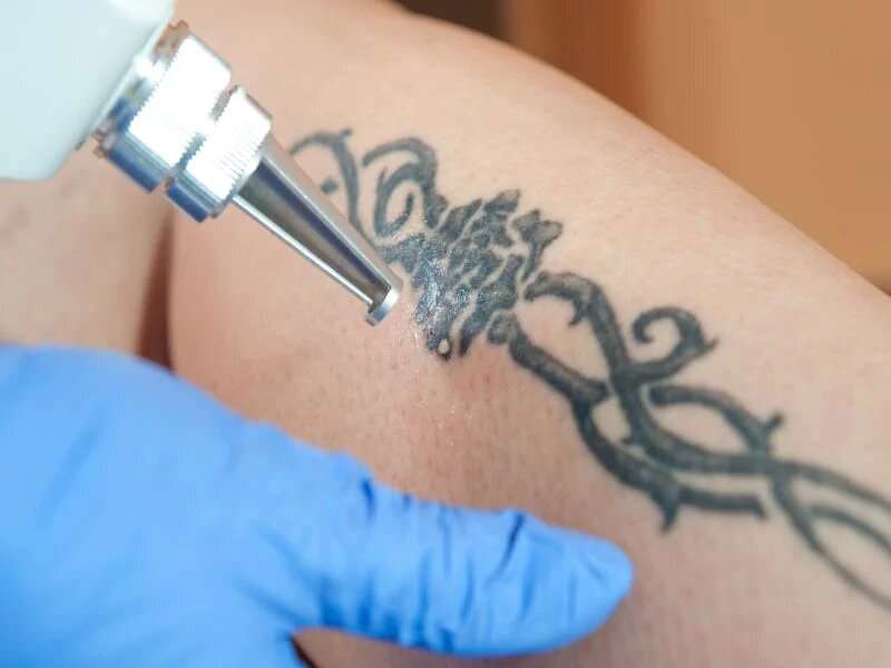 Bad reaction from a new tattoo? here's what to do