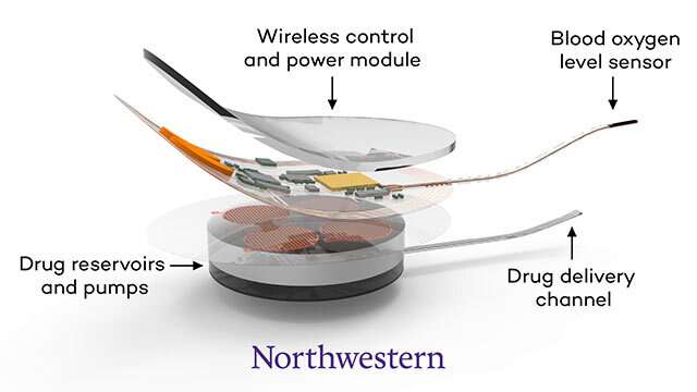 Bioelectronic implant could prevent opioid deaths