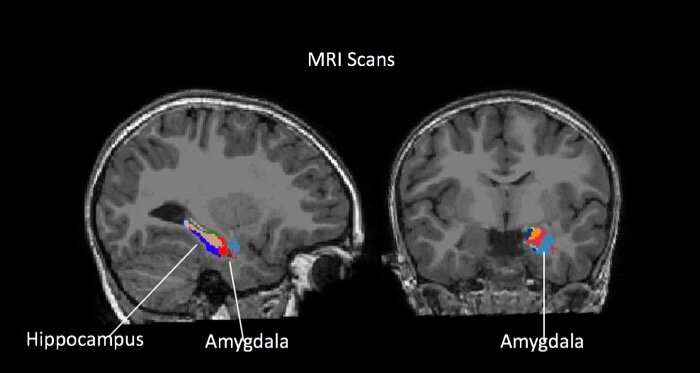 Brain clue signals anxiety, depression in some kids