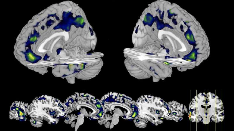 **Brain scans of incarcerated men reveal reduced gray matter in homicide offenders