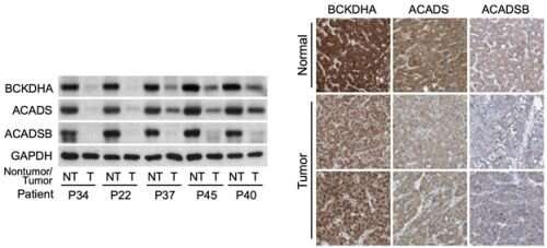 Branched-chain amino acids regulate the development and progression of cancer