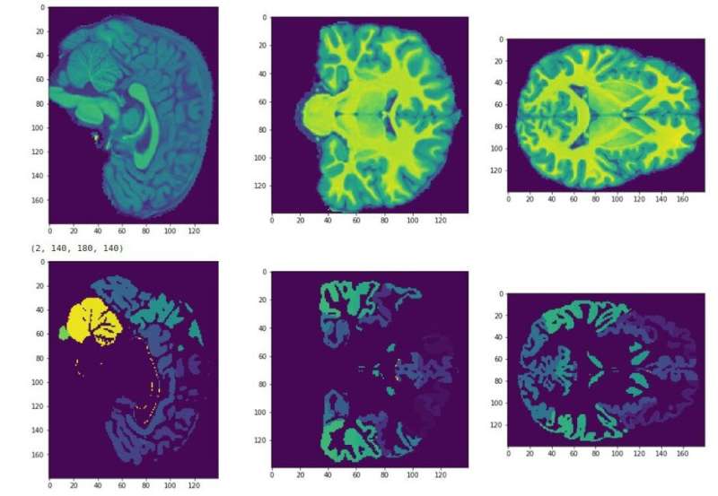 Can MRI predict intelligence levels in children?