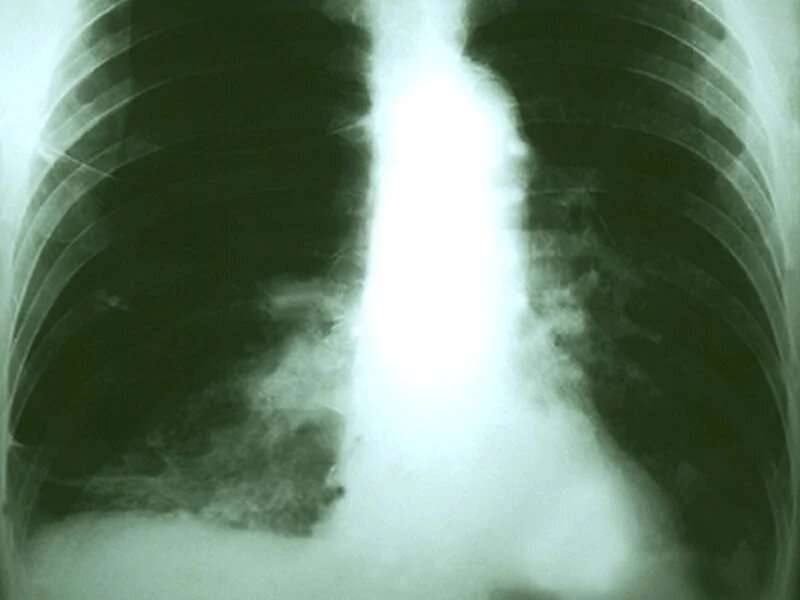Childhood TB shot may offer long-term protection from lung cancer
