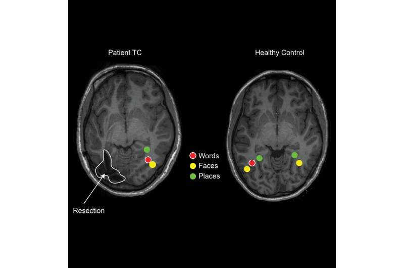 Children's brains reorganize after epilepsy surgery to retain visual perception