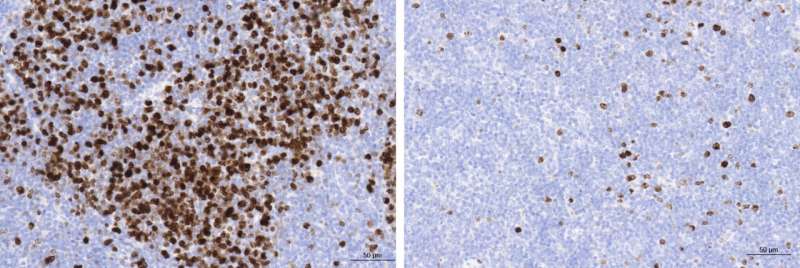 CNIO发现营养物质与滤泡性淋巴瘤之间的联系