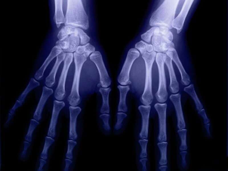 Common sites of bone erosion in rheumatoid arthritis ID'd on US