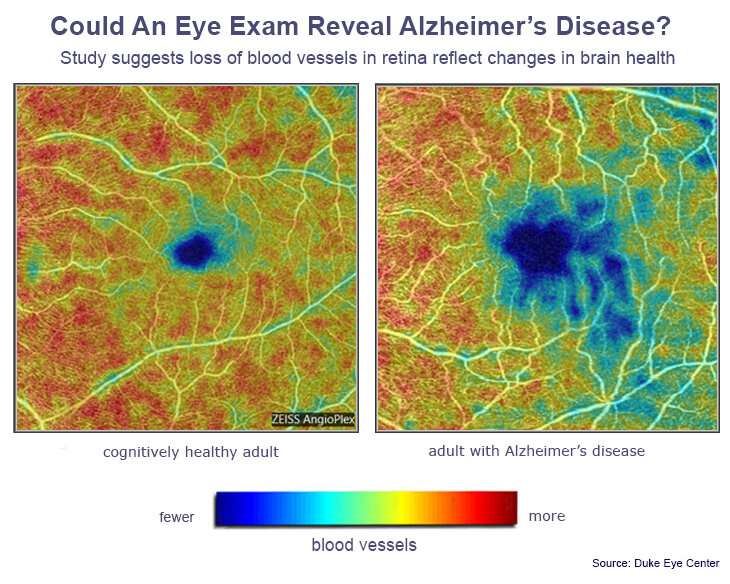 Could an eye doctor diagnose Alzheimer's before you have symptoms?