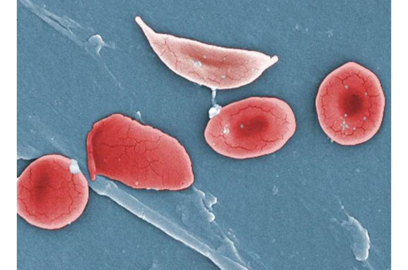 CRISPR provides hope of sickle cell cure