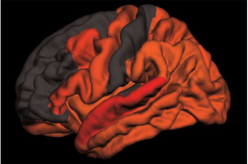 Decreased deep sleep linked to early signs of Alzheimer's disease
