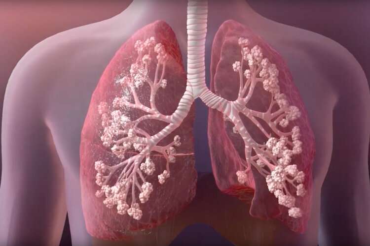 Discovery could improve cystic fibrosis treatment
