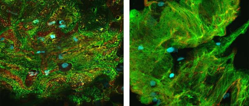 Discovery shows how mucus build-up, not infections, triggers cystic fibrosis lung damage