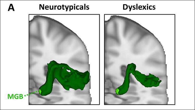 Diving deeper into developmental dyslexia