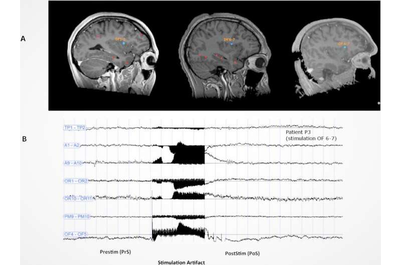 Does stimulation of the brain's dorsal anterior insula trigger ecstasy?
