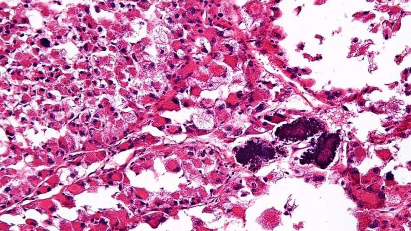Drug that blocks blood vessel growth could treat rare sarcomas