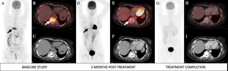 Earlier diagnosis and treatment assessment of tuberculosis achieved with pet/ct