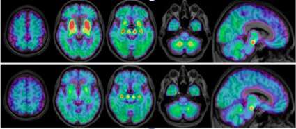 Early biomarker found for degenerative neurologic disease