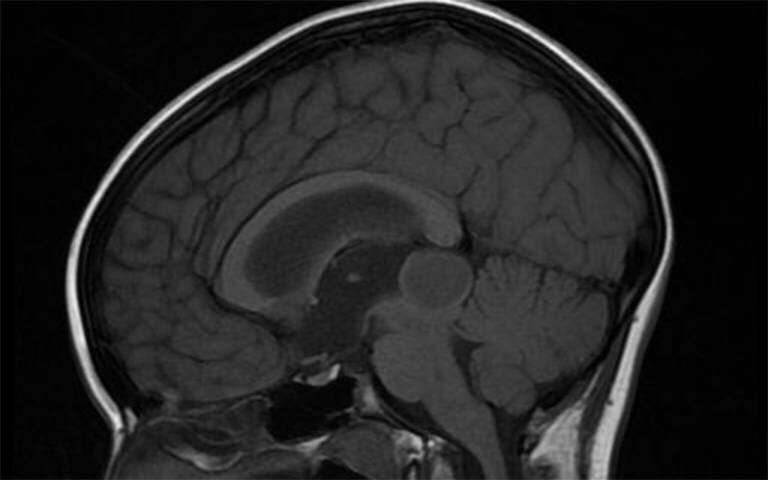 Early removal of slow-growing brain tumours dramatically improves survival | UCL News - UCL - London's Global University