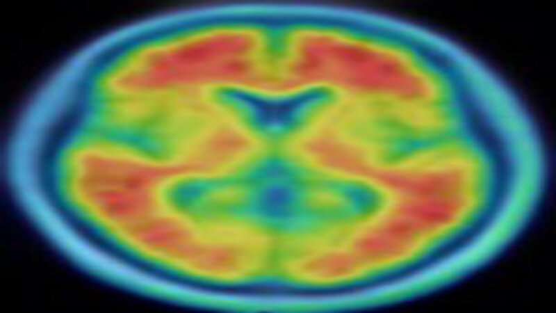 Education, intelligence may protect cognition, but don't prevent Alzheimer's disease