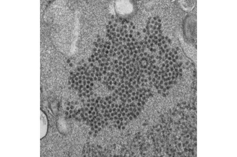 Enterovirus antibodies detected in acute flaccid myelitis patients