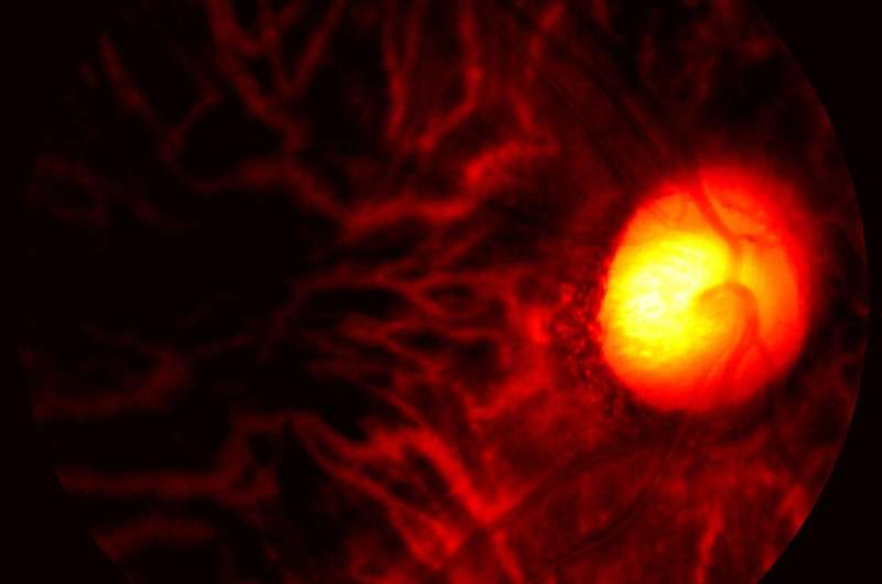 Eye scan sheds new light on Alzheimer's disease