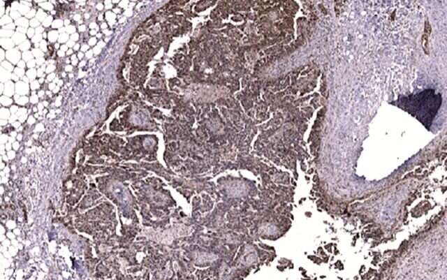 FAK蛋白与卵巢癌中的化疗抗性有关