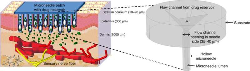 **Glassy Carbon Microneedles – A New Transdermal Drug Delivery Device
