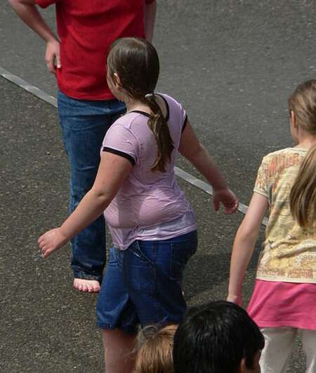 Higher risk of pediatric multiple sclerosis in obese children, poorer response to treatments