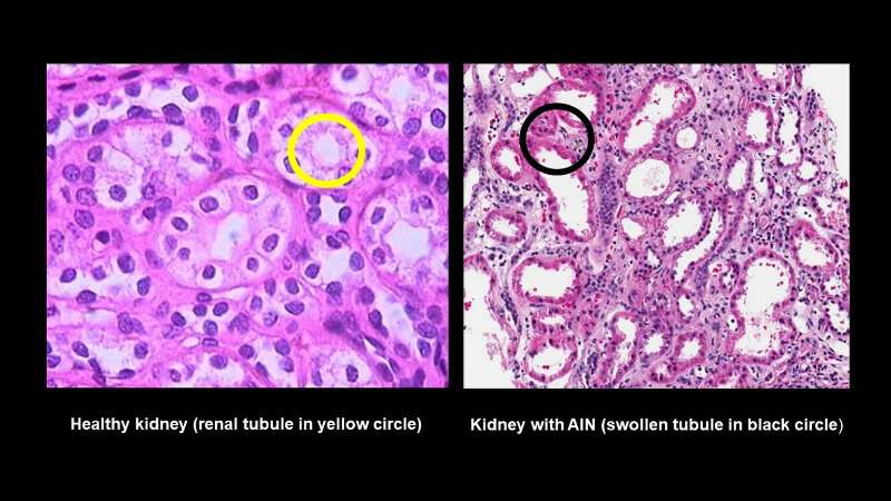 Hopkins-led team finds biomarkers to diagnose serious kidney allergic reaction