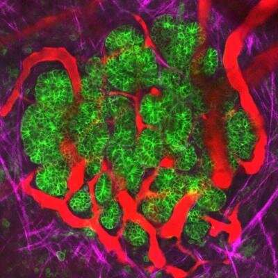 Key to targeting the spread of pancreatic cancer
