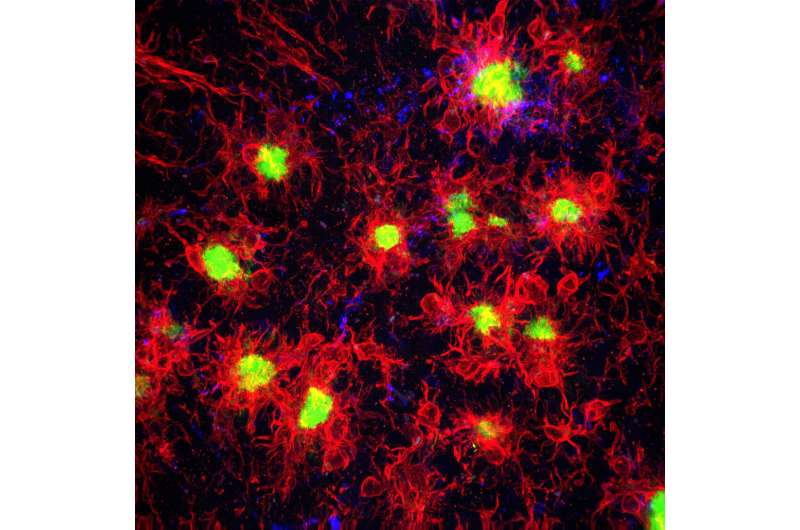 Link between brain immune cells and Alzheimer's disease development identified