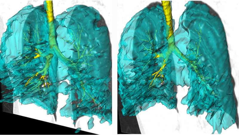 Lung images of twins with asthma add to understanding of the disease