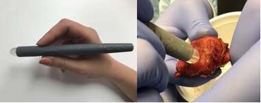 'MasSpec Pen' for accurate cancer detection during surgery