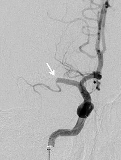 Medical management vs. mechanical thrombectomy for mild strokes: Same safety and effectiveness